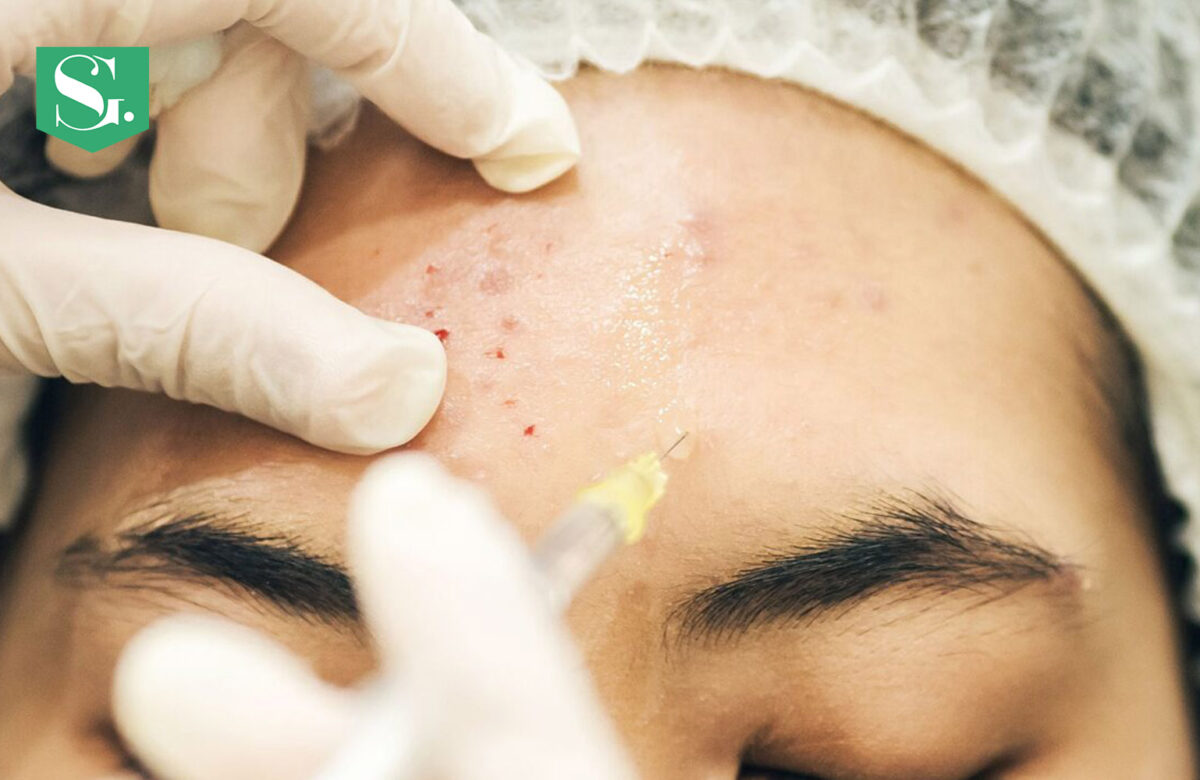 Does Botox Help With Acne: Separating Myths from Facts