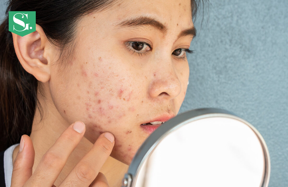 What Age Is Acne The Worst: Navigating the Stormy Seas of Skin