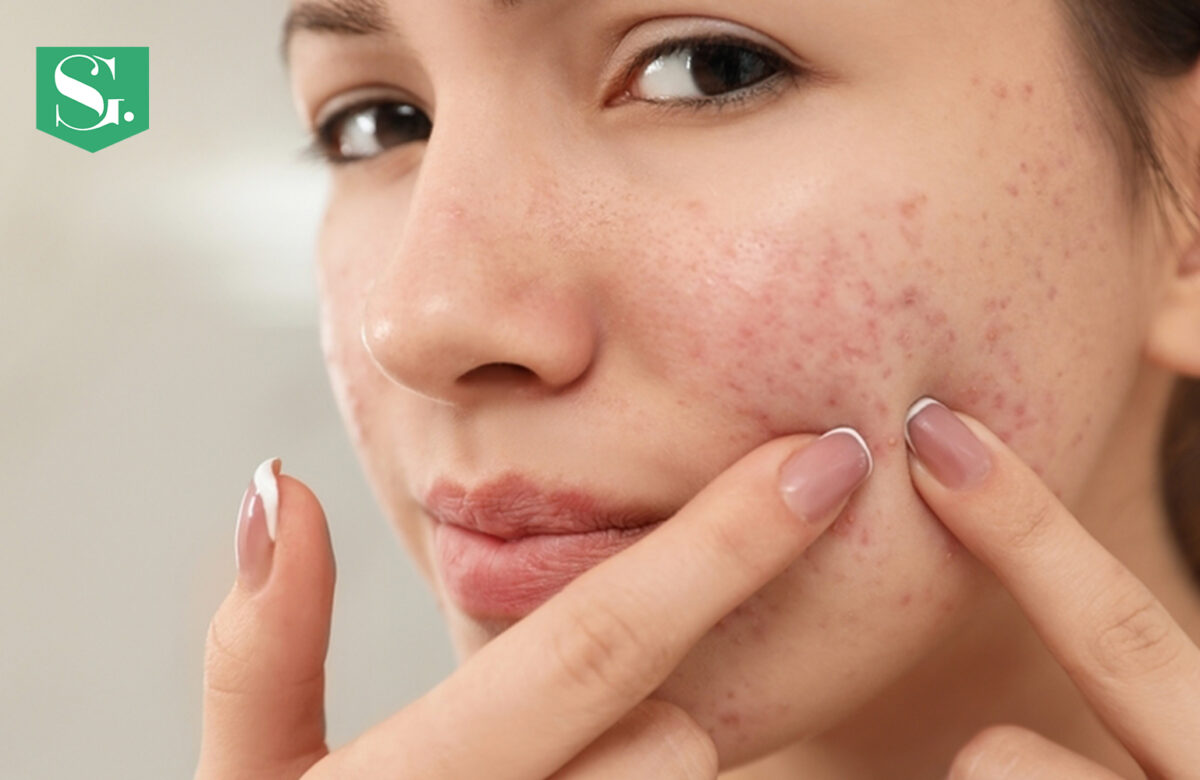 Why Do My Acne Scars Look Worse Some Days?