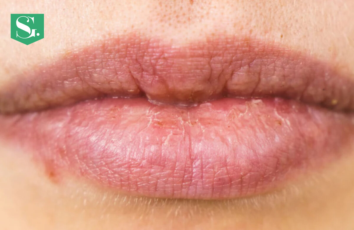 How To Get Rid Of Scars On Lips?