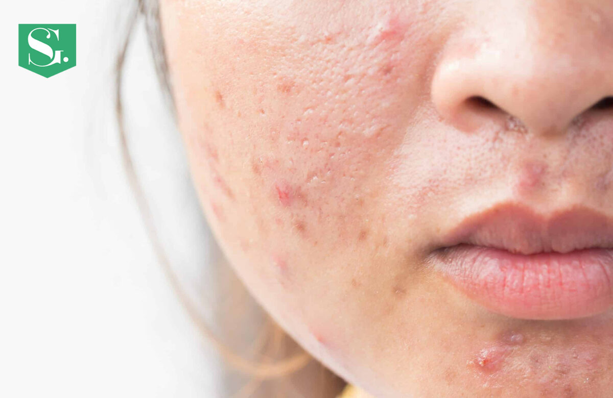 How To Remove Acne Scars Naturally In A Week?