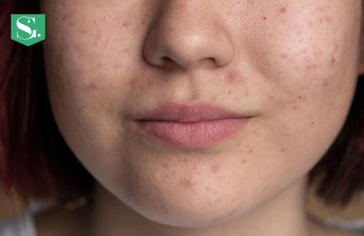 Can Hyaluronic Acid Cause Acne?