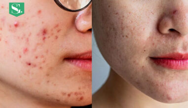 acne-marks-vs-acne-scars