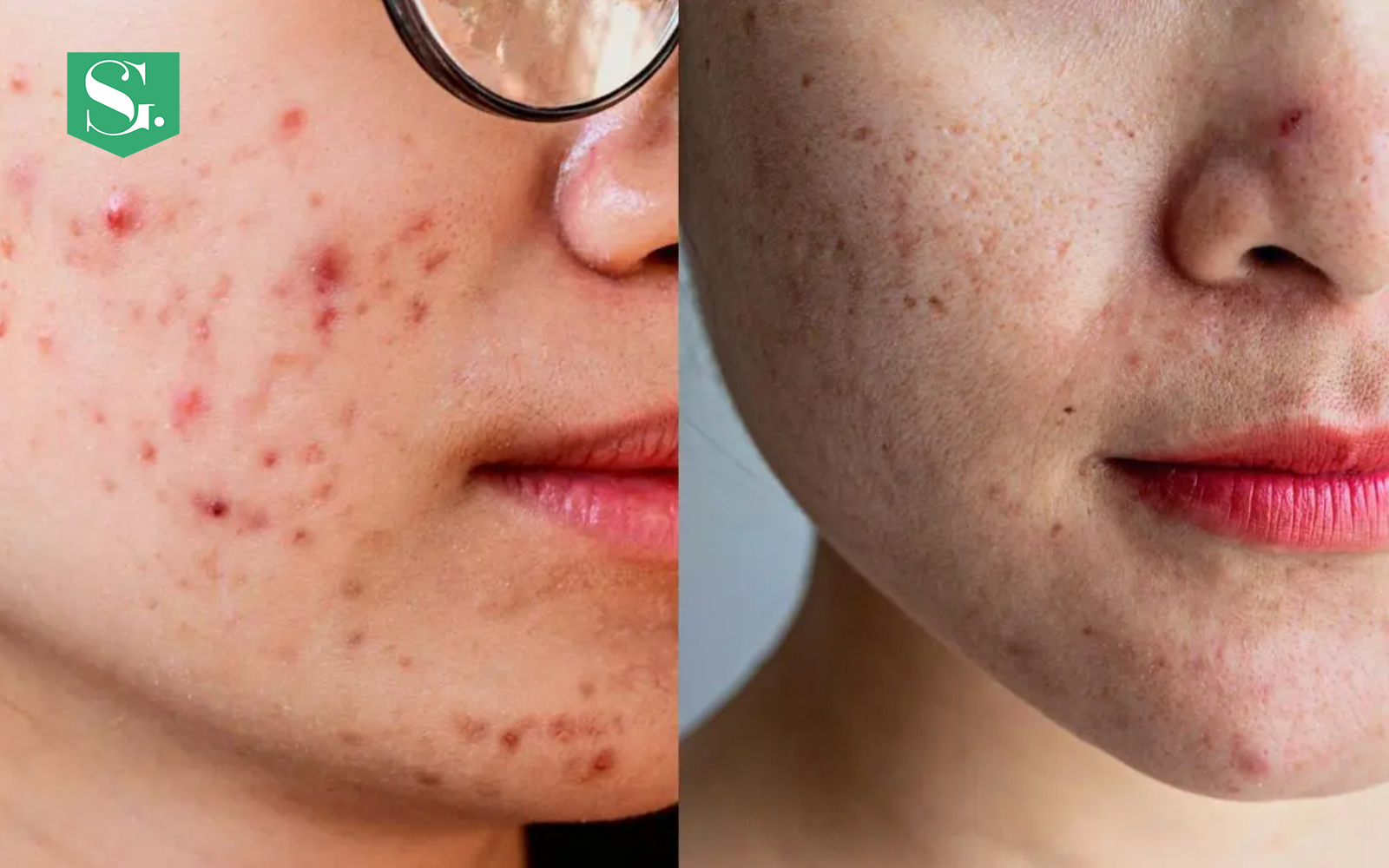 acne-marks-vs-acne-scars